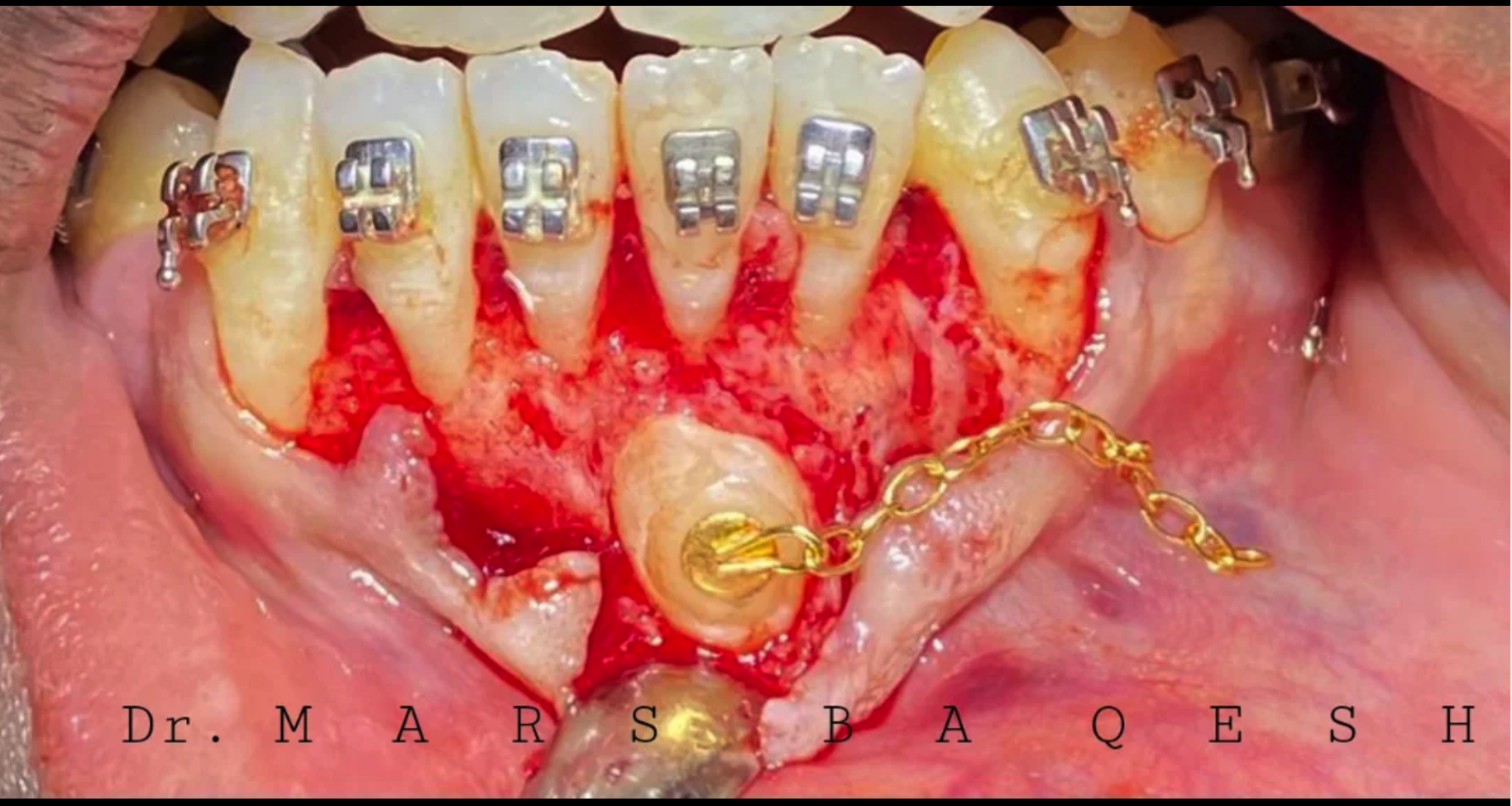 Oral Surgery